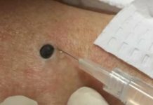 ŽENA JE GAJILA OVO NA LEĐIMA: Kada je doktorka uzela špric i bocnula, shvatit ćete zašto je SNIMAK pregledalo 33 miliona ljudi!