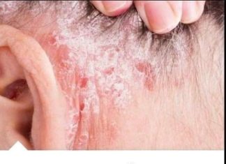 NE BACAJTE NI SLUČAJNO KORU OD OVE VOĆKE – Liječi psorijazu, skida bradavice i izbjeljuje zube