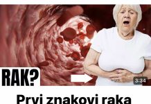 Prvi znakovi raka debelog crijeva koje žene ignoriraju!
