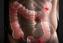 ONKOLOG UPOZORAVA: Ovaj ‘tihi’ simptom raka crijeva mnogi ignorišu…