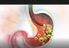 5 ranih simptoma raka želuca: Tumor može da raste godinama, a svi pacijenti prvo osjete ovo…
