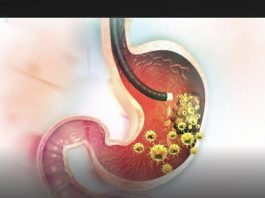 5 ranih simptoma raka želuca: Tumor može da raste godinama, a svi pacijenti prvo osjete ovo…