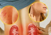 Znaci otkazivanja bubrega koji, ako se ignorišu, mogu zahtevati doživotnu dijalizu!