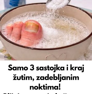 Samo 3 sastojka za žute i zadebljale nokte! GLJIVICE NA NOKTIMA KAO RUKOM ODNESENE…